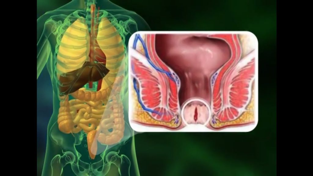 Sente dores fortes no ânus ou reto e não sabe o que é? Pode ser hemorroida,  doença caracterizada - InMeD